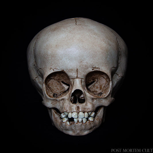 This handcrafted child skull replica, modeled after a 16-month-old, offers remarkable detail, from the open anterior fontanelle to the developing milk teeth. Made of durable polyurethane resin and hand-painted for authenticity, it’s a perfect addition for anatomical studies, artistic references, or as an exceptional piece for collectors. Perfect for those interested in human anatomy or as a unique decorative item for medical-themed spaces.